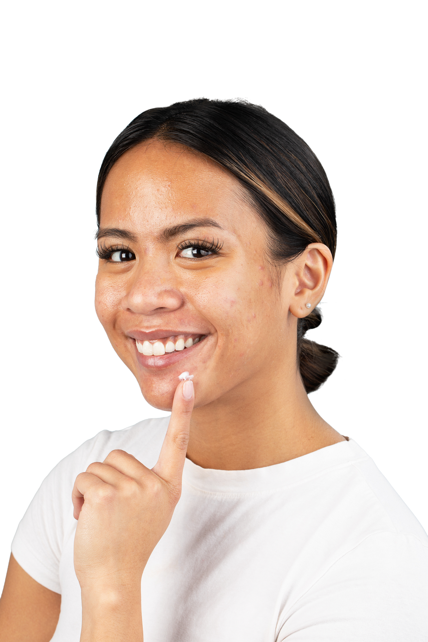 ACNE 101: KNOW YOUR ENEMY